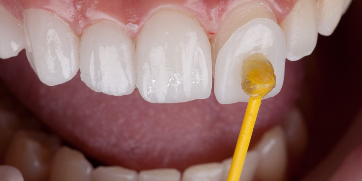 Carillas Dentales