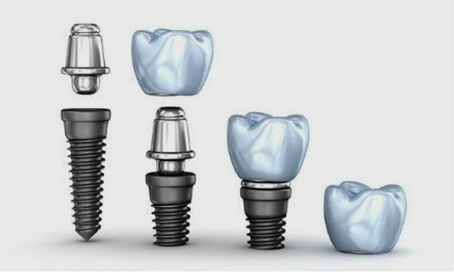 Implante dental